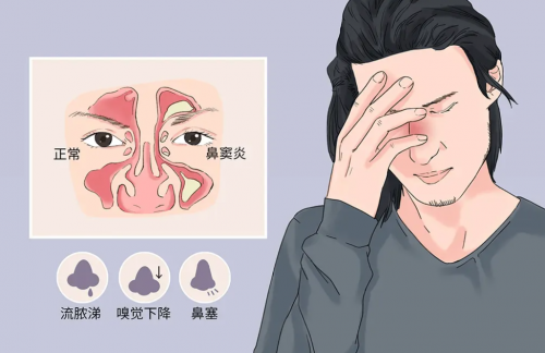 清鼻堂：患上鼻窦炎，三大危害千万要警惕！
