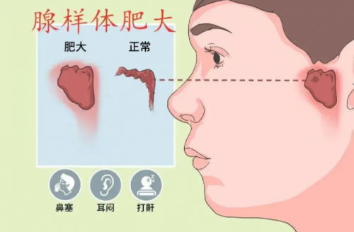 清鼻堂：孩子腺样体肥大，家长一定要知道的事！
