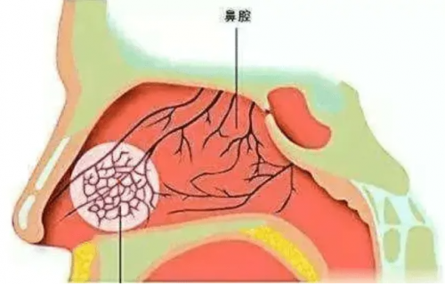 清鼻堂：釜底抽薪！想要告别鼻炎鼻窦炎，从修复鼻粘膜开始