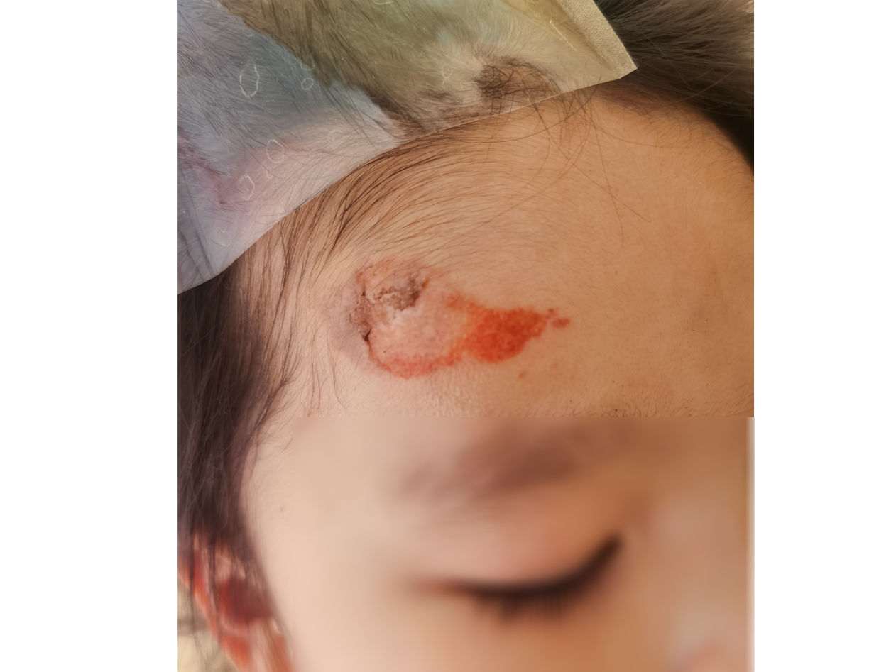 烟花轨迹突然偏移 钻进女童毛线帽致额头烧焦